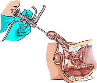 Ureteroscopy eljárás